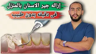 إزالة جير الاسنان فى المنزل بدون طبيب 👌💯 | 7 طرق طبيعية لإزالة جير الاسنان 💥🦷