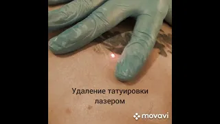 Удаление татуировки лазером в Пятигорске