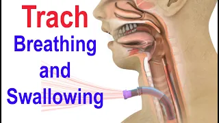 Trach Breathing and Swallowing
