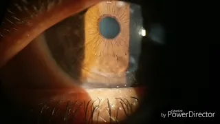 Keratoplasty