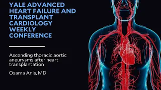 Ascending thoracic aortic aneurysms after heart transplantation