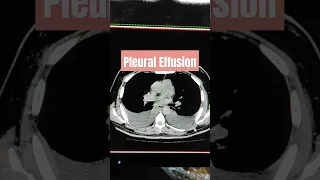 Pleural Effusion CT chest #shorts #viral