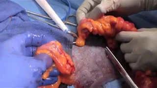 Robotic Sigmoidectomy for Chronic Complicated Diverticular Disease