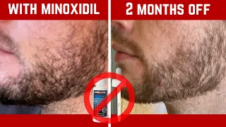 What Happened When I Stopped Minoxidil for Beard Growth?
