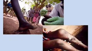 Guinea worm disease by Deborah  BGM: Canon