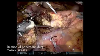 Robotic Pancreato-jejunostomy anastomosis (Whipple procedure, Modified Blumgart)
