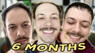 my first 6 MONTH with a FUT Hair Transplant (2023 US Surgury)