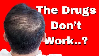 Hair Thinning: Ditch or Deploy? Minoxidil, Finasteride, Red Laser Light, PRP Explored