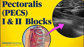 Pectoralis (PECS) blocks I & II