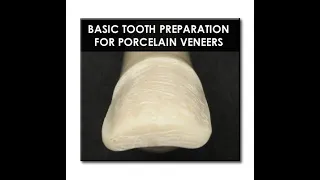 Basic Tooth Preparation for Porcelain Veneers