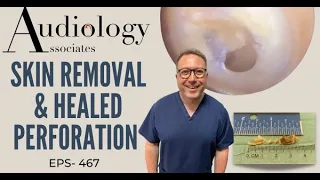 SKIN REMOVAL & HEALED PERFORATION - EP 467