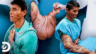 Mulher recusa tratamento para tratar um tumor no braço | Meu Corpo, Meu Desafio | Discovery Brasil