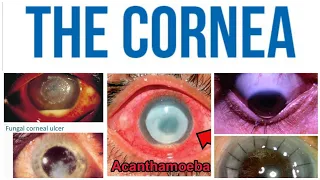Cornea 2 Major Topic: Keratitis and Bacterial Corneal Ulcer Part 1