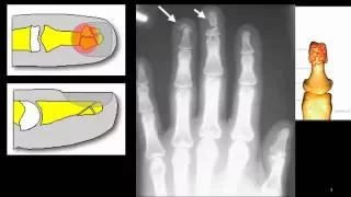 tuft fracture - fracture of the distal finger tip