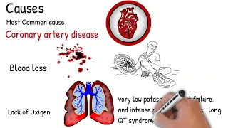 Sudden cardiac death - Causes, Risk factors, prevention, treatment