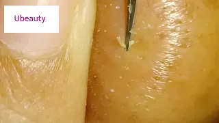 No squeezing whiteheads removal (Facial 38 nosetip)