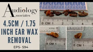 4.5CM/1.75IN EAR WAX REMOVAL - EP594