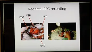 EEGs and Neonatal Babies