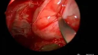 Endoscopic Orbital Decompression with Septoplasty