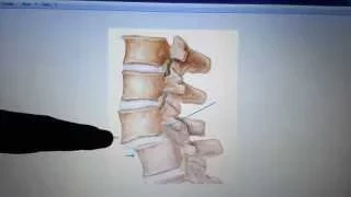 Spondylisthesis