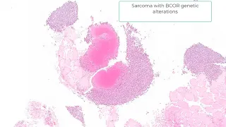 Ewing Family of Tumors