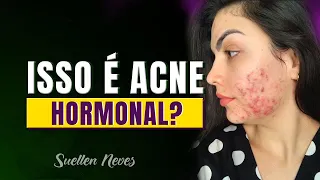 ACNE HORMONAL: COMO SABER SE VOCÊ TEM e por quê toda Acne é Hormonal? (acne da mulher adulta)
