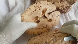 Sections of brain - gross anatomy