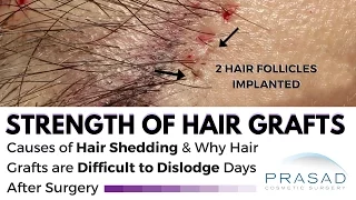 Post Hair Transplant - Grafts are Too Strong to Fall Out, but Shedding Does Happen