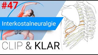 Interkostalneuralgie erklärt - Zwischen-Rippen-Nervenschmerz