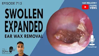 715 - Swollen Expanded Ear Wax Removal