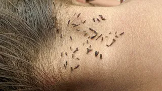 Picking out all hundred head lice - Remove all thousand lice from head