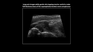 Full-thickness tear of the supraspinatus tendon on shoulder ultrasound (case 6)