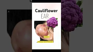 Complete Guide: #cauliflower #Ear Drainage and Proper #dressing
