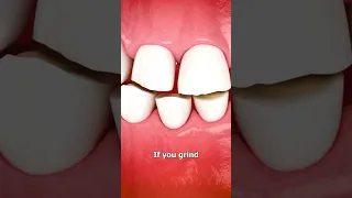 Why grinding your teeth is so bad 😣