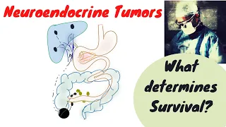 Neuroendocrine Tumors; What determines outcome?