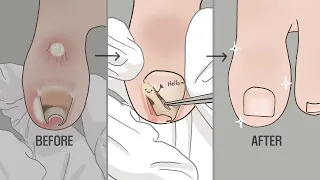[Tingle ASMR Animation Ep.2] Ingrown Toenail Removal Treatment with Stimulating Sound / LULUPANG