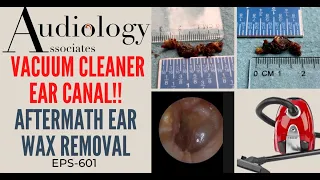 VACUUM CLEANER EAR WAX REMOVAL - EP601