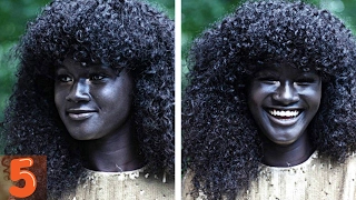 5  People With Unique Skin Colors