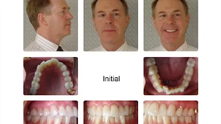 Orthodontic Treatment: Accelerated Orthodontics May 16, 2017