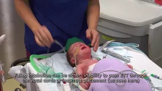 Paediatric Anaesthetics: Chapter 3 - Failed intubation neonate