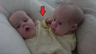 Этих сиамских близнецов "разделили" в 2006 году. Вот что с ними стало через 17 лет!