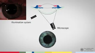 Slit Lamp Techniques   Conical Beam