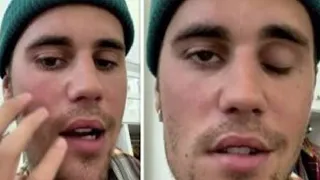 Justin Bieber Reveals Shocking Diagnosis Leaving Part Of His Face Paralyzed!