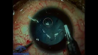 Corneal Tear Repair Surgery