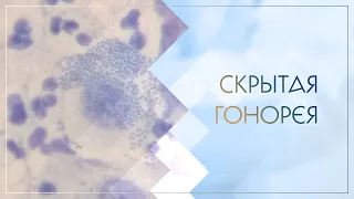 👉 Скрытая гонорея. Клинический случай №51