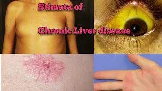 Stimata of Chronic liver disease|medicine Classroom |Dr Bhupendra Shah