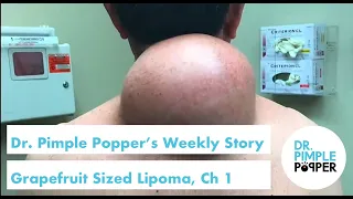 Dr. Pimple Popper's Weekly Story: Grapefruit Sized Lipoma, Chapter 1