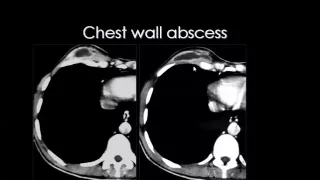 Imaging of Chest wall lesions   DRE 10   Dr Mamdouh Mahfouz