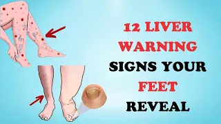 What Your Feet Can Tell You About Your Liver: 12 Warning Signs | Healthy Care