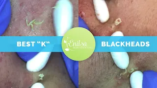 "K's" Best Blackhead Extraction Compilation Part #1